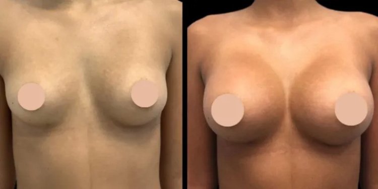 The Best breast Enlargement surgeons in dubai How to Ensure a Safe Surgery Experience