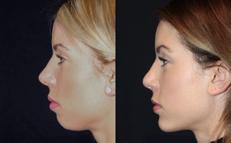 Chin Fillers Treatments in Dubai: The Latest Techniques and Trends