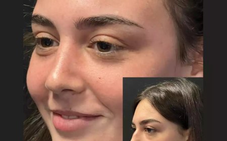 What Recovery Looks Like After Nose Surgery in Dubai