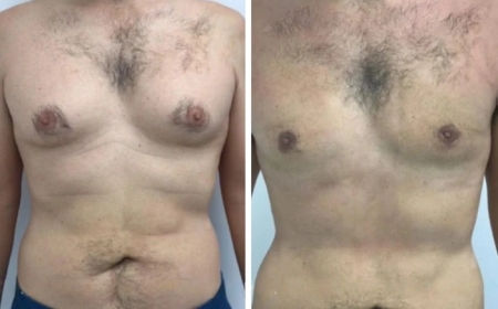 Gynecomastia Surgery in dubai: A Detailed Step-by-Step Process