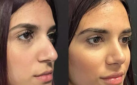 How Long Do Results Last After Nose Surgery in Dubai?