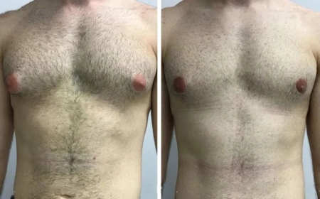 he Latest Techniques Used for Gynecomastia Surgery in Dubai