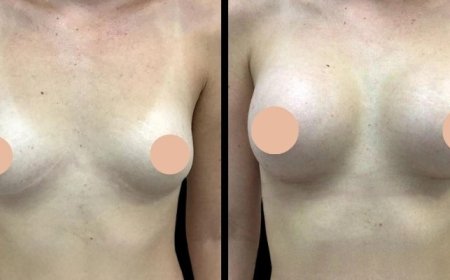 Breast Augmentation Surgery in Dubai: How to Maintain Your Results Over Time