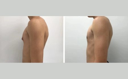 Gynecomastia Surgery Cost in Dubai: What’s Included?