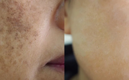Pigmentation Treatment Exploring New Advances in Pigmentation Treatment Technology
