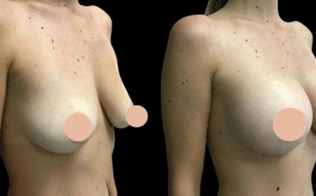 Confidence Redefined: Breast Augmentation Surgery in Dubai