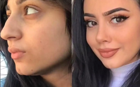 A Complete Guide to the Best Rhinoplasty Surgeon in Dubai