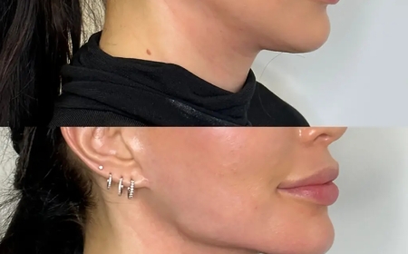 Jawline Fillers and Facial Balance: Recommendations from the Best Aesthetic Clinic in Dubai