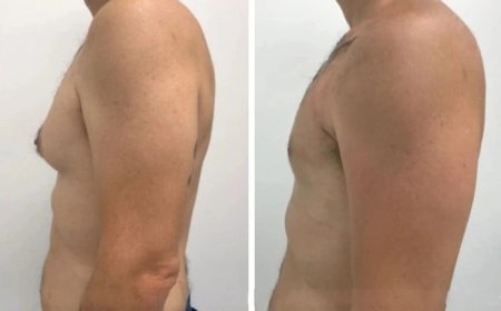 Understanding the Full Recovery Process After Gynecomastia in Dubai