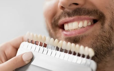 Affordable Veneers for a Stunning Smile Makeover