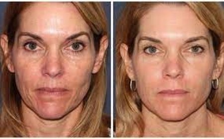 Discover the Power of Laser Resurfacing Near You