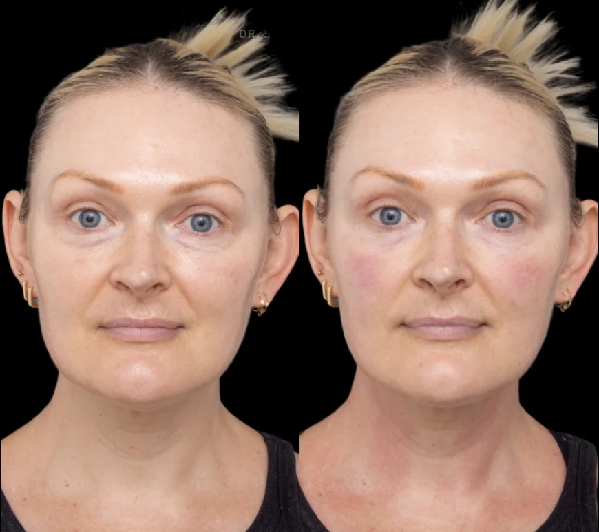 Best Doctors in Dubai: Providing Customized Solutions for Under Eye Fillers