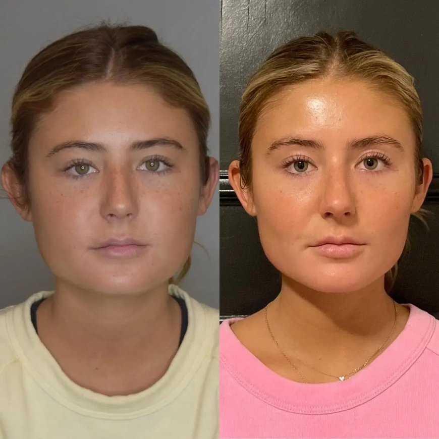 Buccal fat removal Surgery in Dubai: Future Trends in Cosmetic Surgery