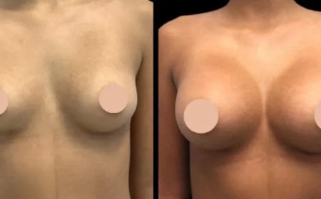 Breast Augmentation Surgery in Dubai: Understanding the Different Incision Types