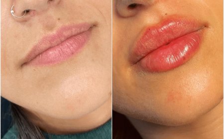 Juvederm for Age Spots and Sun Damage: How the Best Plastic Surgeons in Dubai Treat Skin Imperfections