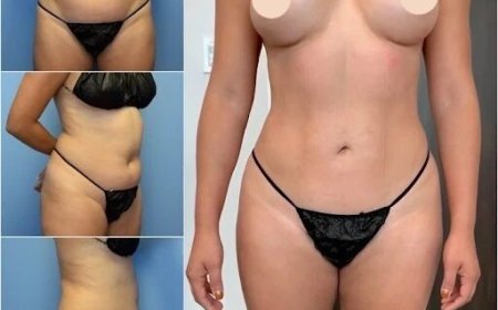 Body Contouring in Dubai for Stubborn Fat: Is It Worth It?