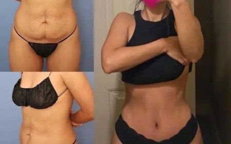 What Is the Difference Between Full and Mini Tummy Tuck in Dubai?