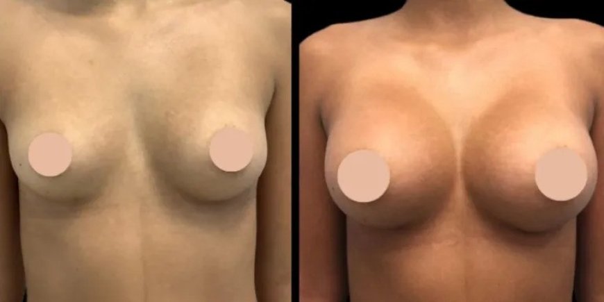 Breast Augmentation Surgery in Dubai: Understanding the Different Incision Types