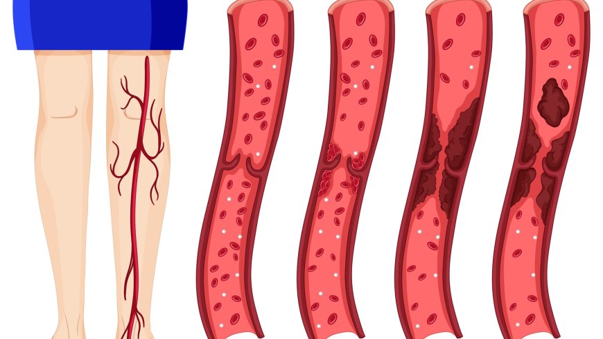 Blood Clot in Leg Symptoms Explained: Causes, Signs, and Treatment