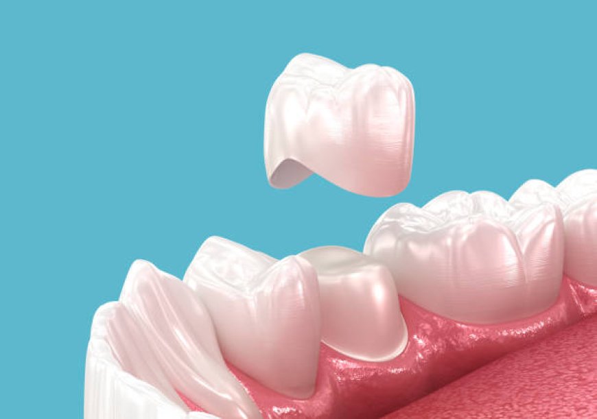 When Do You Actually Need a Dental Crown? Common Scenarios Explained
